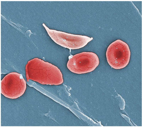 If both parents have sickle cell trait, how likely is their child to have  sickle cell anemia? - The Tech Interactive