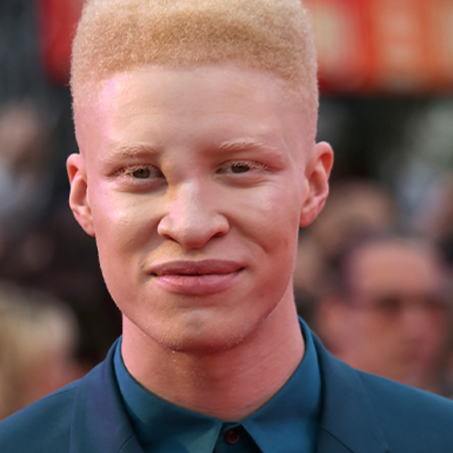 albino african