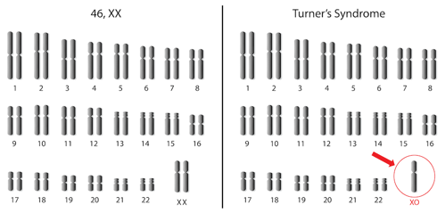 turner syndrome chromosome