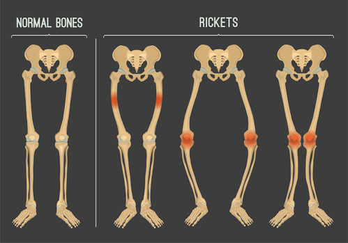 Rickets