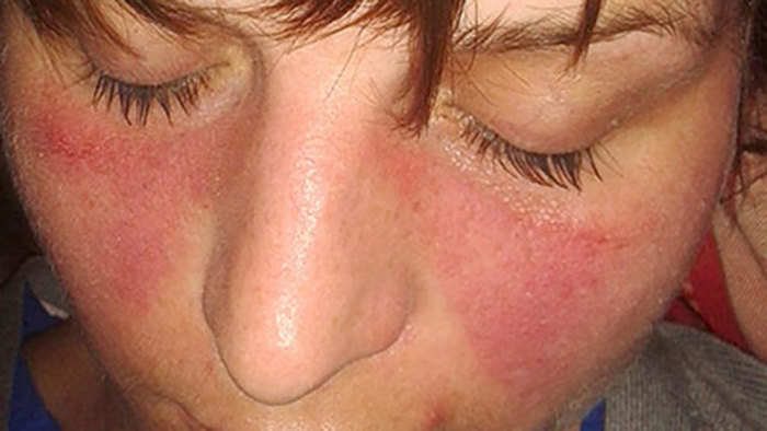 Lupus rash.