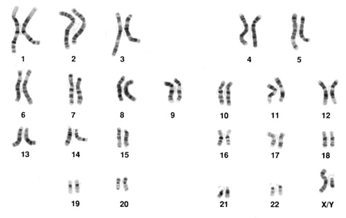 double trisomy